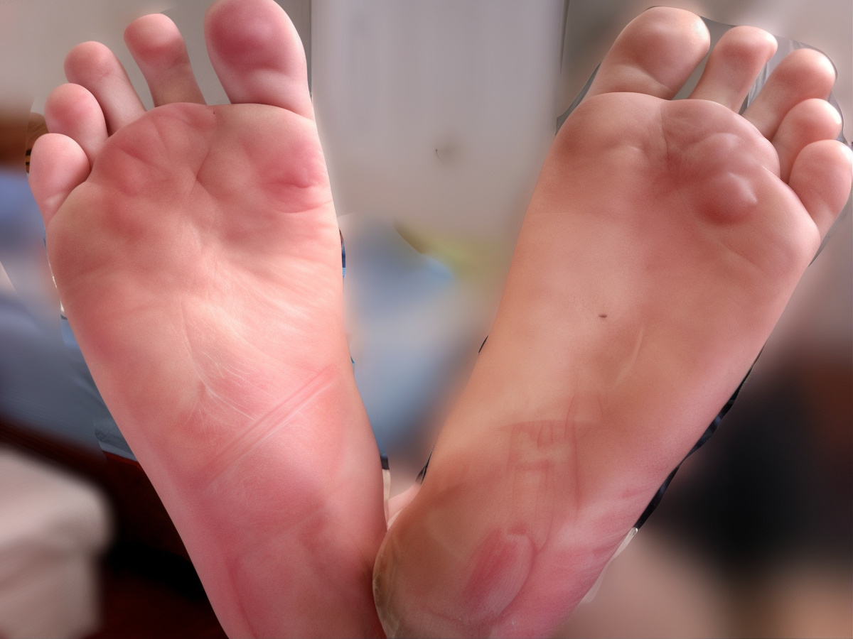 blisters on the sole of a foot while camping